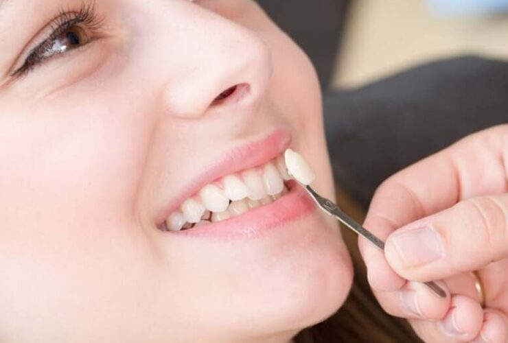Veneers Kosten Türkei