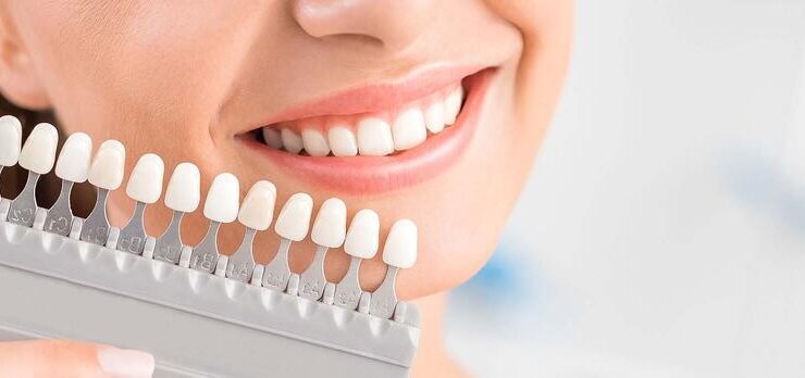 Wer ist kein guter Kandidat für Veneers?